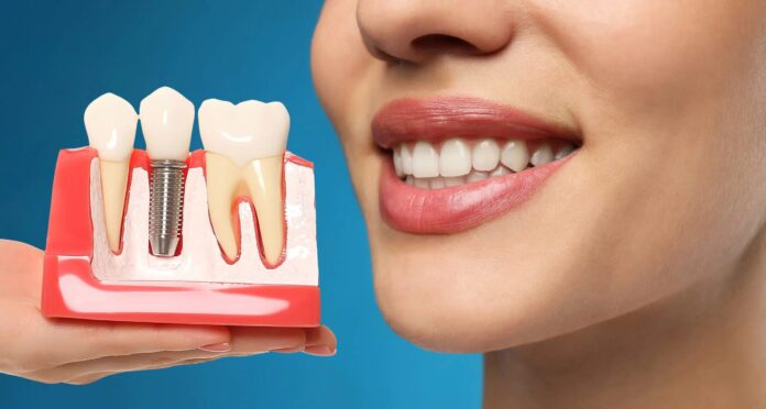 Dental Implants in Manchester